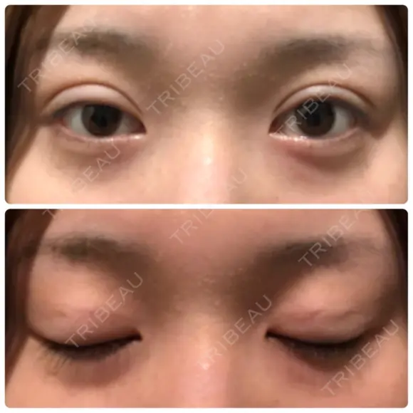 二重埋没 湘南美容クリニック 新宿南口院 DAY 10 メイン用