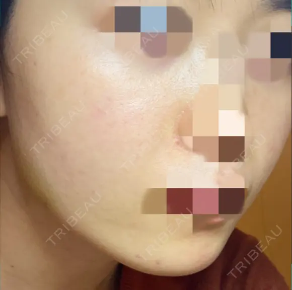 ボトックス（エラ・小顔） TCB東京中央美容外科 上野院 DAY 7 メイン用