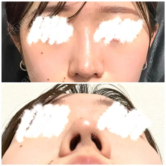 鼻尖形成（切開） / 小鼻縮小（切開） / 軟骨移植 / 鼻尖縮小 高崎美容クリニック DAY 40 メイン用