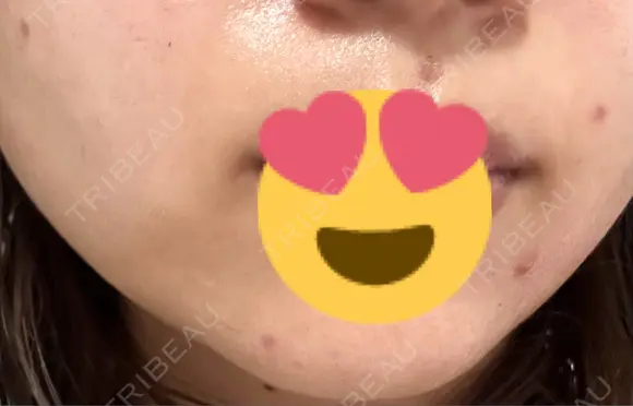 ほくろ・いぼ切除（肌） しらさぎ形成クリニック 徳島院 DAY 50 メイン用