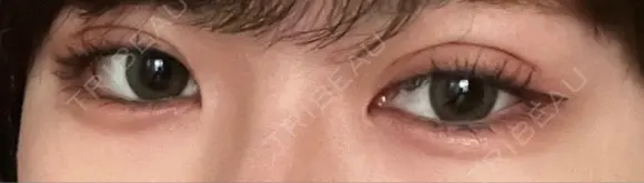 二重埋没 湘南美容クリニック 仙台院 DAY 18 メイン用