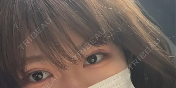 二重埋没 湘南美容クリニック 仙台院 DAY 22 メイン用