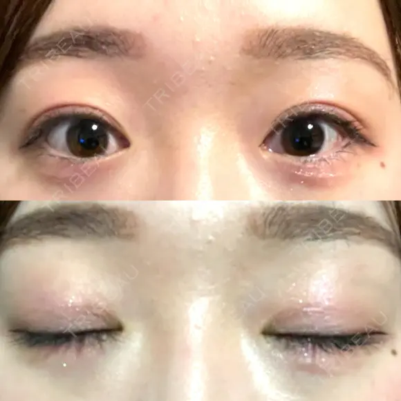 二重埋没 水の森美容クリニック 大阪梅田院 DAY 369 メイン用