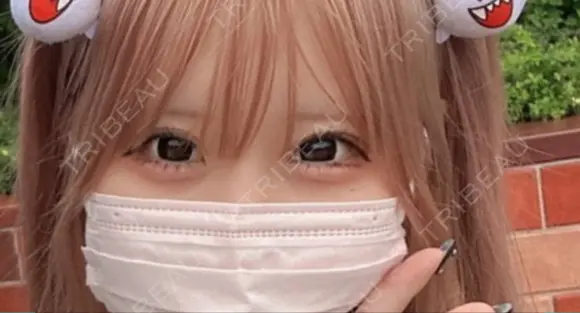 ヒアルロン酸注入（目の下） 宇都宮ひふ科形成外科 DAY 0 メイン用