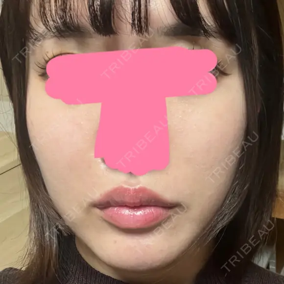 ヒアルロン酸注入（唇） / ボトックス（口角） / ヒアルロン酸注入（頬） KAGA CLINIC DAY 0 メイン用