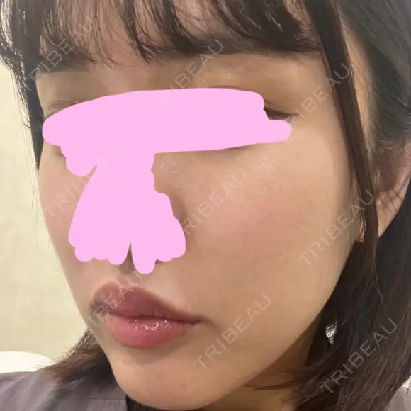 ヒアルロン酸注入（唇） / ボトックス（口角） / ヒアルロン酸注入（頬） KAGA CLINIC DAY 0 メイン用