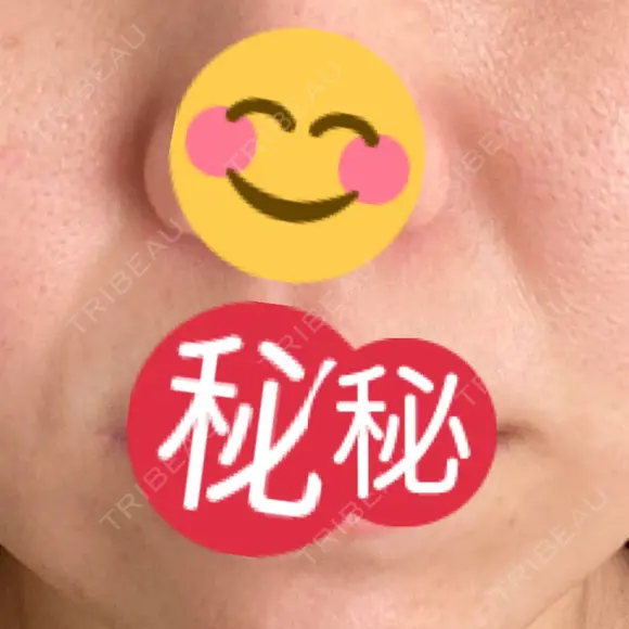 PRP皮膚再生療法 聖心美容クリニック 六本木院 DAY 20 メイン用