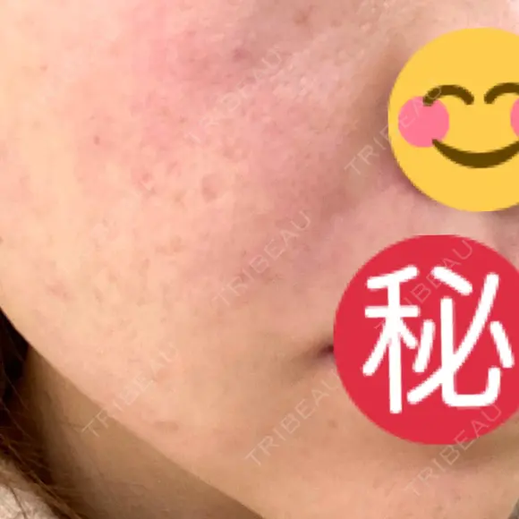 PRP皮膚再生療法 聖心美容クリニック 六本木院 DAY 26 メイン用