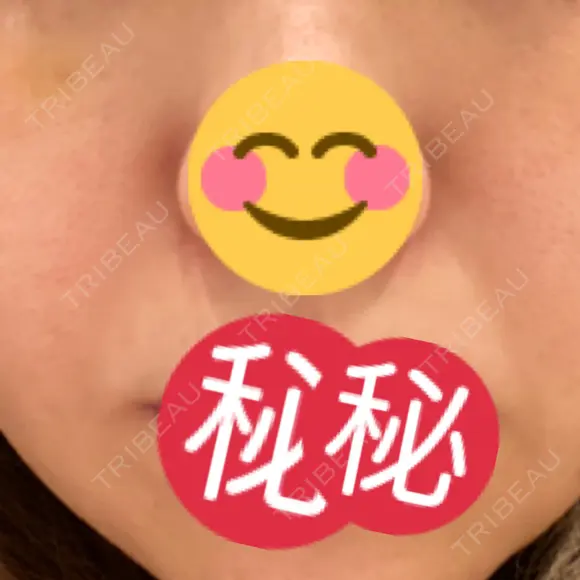 PRP皮膚再生療法 聖心美容クリニック 六本木院 DAY 72 メイン用