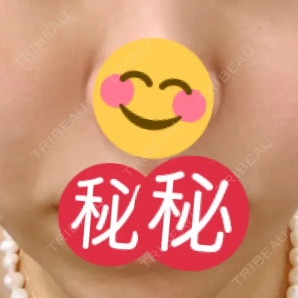 PRP皮膚再生療法 聖心美容クリニック 六本木院 DAY 121 メイン用