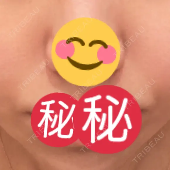 PRP皮膚再生療法 聖心美容クリニック 六本木院 AFTER メイン用