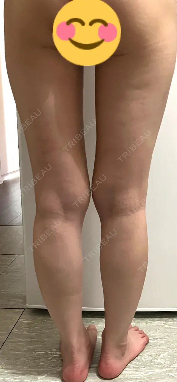 脂肪吸引（脚） / 豊胸（脂肪注入） GAYA body design clinic DAY 16 メイン用