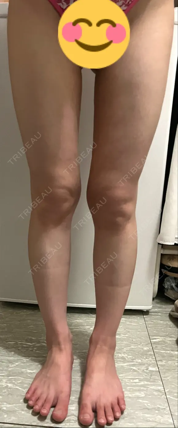 脂肪吸引（脚） / 豊胸（脂肪注入） GAYA body design clinic DAY 16 メイン用