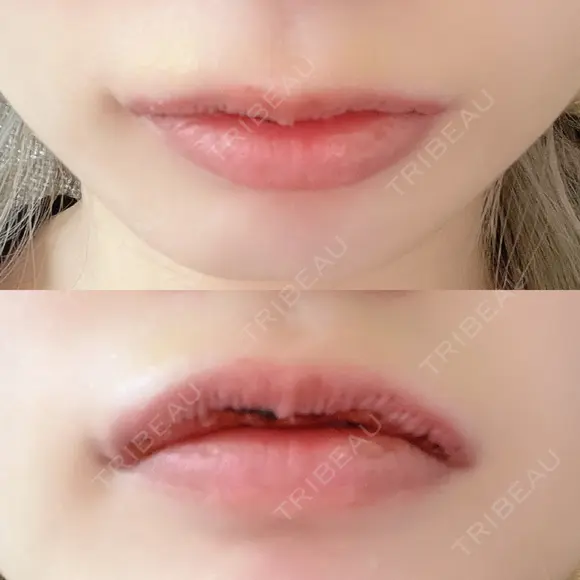 口唇縮小術 B-LINE CLINIC 池袋院 DAY 3 メイン用