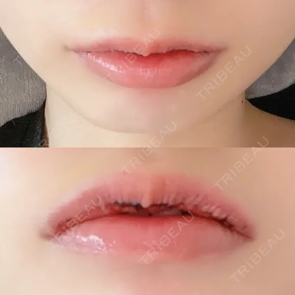 口唇縮小術 B-LINE CLINIC 池袋院 DAY 4 メイン用