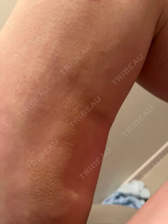 脂肪吸引（脚） / 豊胸（脂肪注入） GAYA body design clinic DAY 18 メイン用