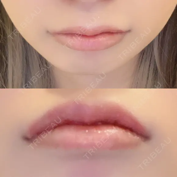 口唇縮小術 B-LINE CLINIC 池袋院 DAY 5 メイン用