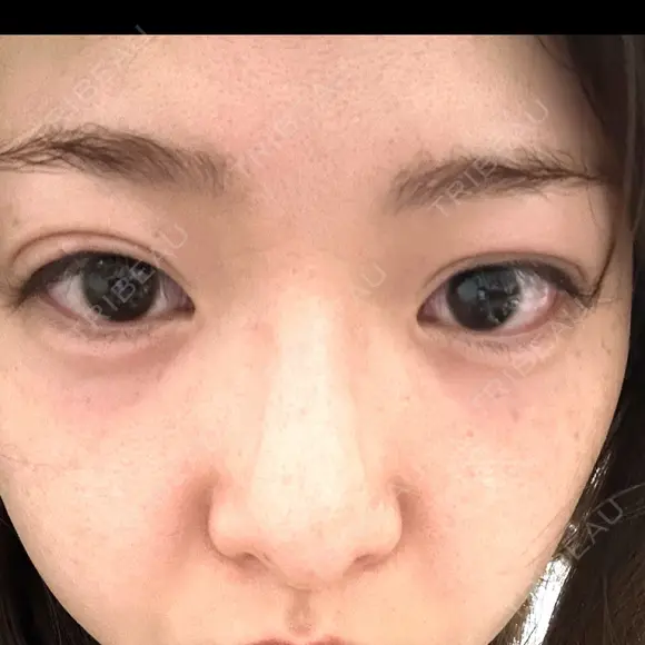 ヒアルロン酸注入（涙袋） Olino美容外科・美容皮膚科 AFTER メイン用