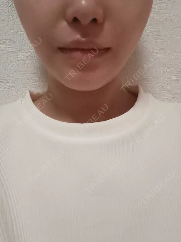 小鼻縮小（切開） / 人中短縮 / 口角挙上 / その他（口元） オザキクリニック LUXE新宿 AFTER メイン用