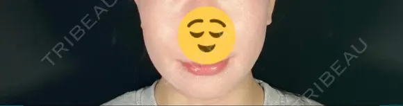 糸リフト / 脂肪吸引（顔） / ボトックス（エラ・小顔） TOTAL BEAUTY CLINIC DAY 8 メイン用