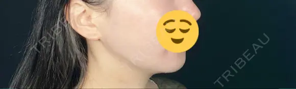 糸リフト / 脂肪吸引（顔） / ボトックス（エラ・小顔） TOTAL BEAUTY CLINIC AFTER メイン用