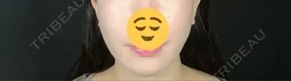 糸リフト / 脂肪吸引（顔） / ボトックス（エラ・小顔） TOTAL BEAUTY CLINIC DAY 27 メイン用