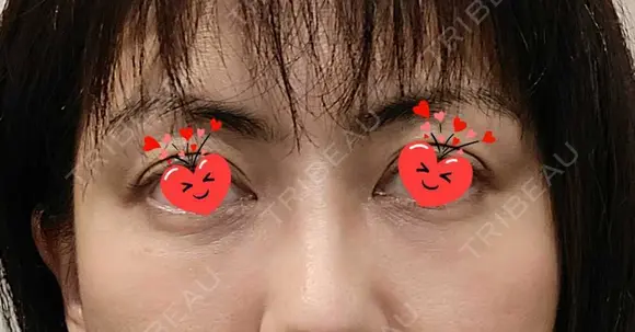 クマ治療 / 脂肪注入（目の下） あじまビューティークリニック DAY 0 メイン用