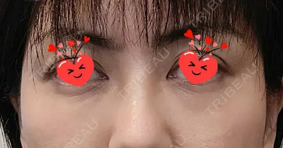 クマ治療 / 脂肪注入（目の下） あじまビューティークリニック DAY 1 メイン用