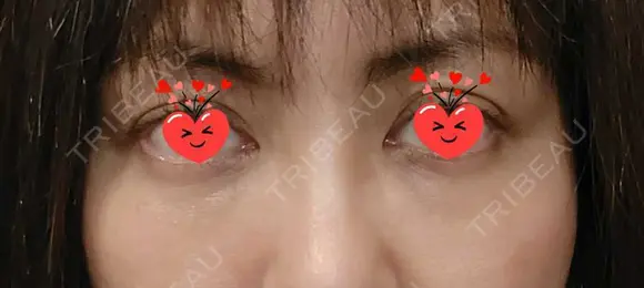 クマ治療 / 脂肪注入（目の下） あじまビューティークリニック DAY 3 メイン用