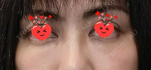 クマ治療 / 脂肪注入（目の下） あじまビューティークリニック DAY 6 メイン用