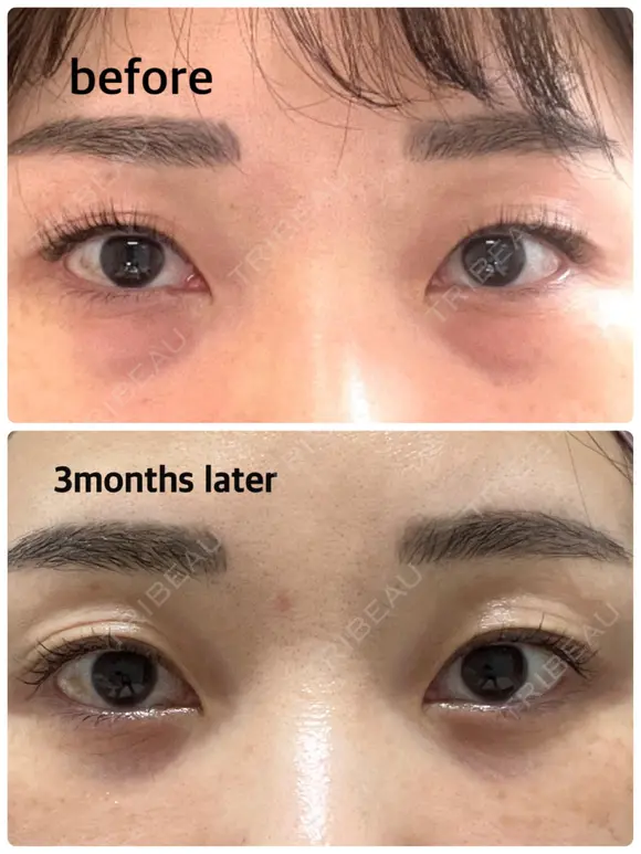 下まぶたの脂肪取り / 脂肪注入（目の下） セオリークリニック AFTER メイン用