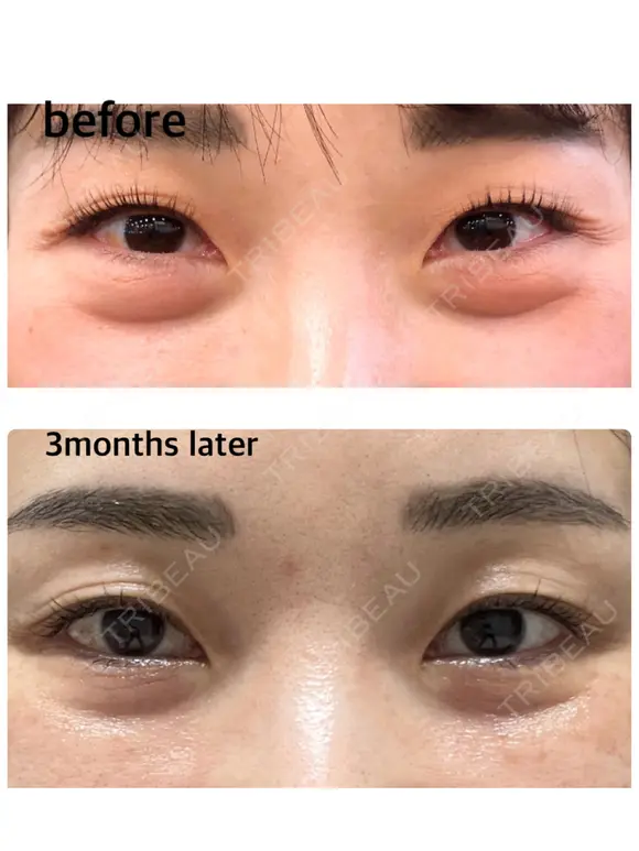 下まぶたの脂肪取り / 脂肪注入（目の下） セオリークリニック DAY 95 メイン用