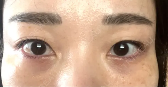 下まぶたの脂肪取り / 脂肪注入（目の下） セオリークリニック DAY 62 メイン用