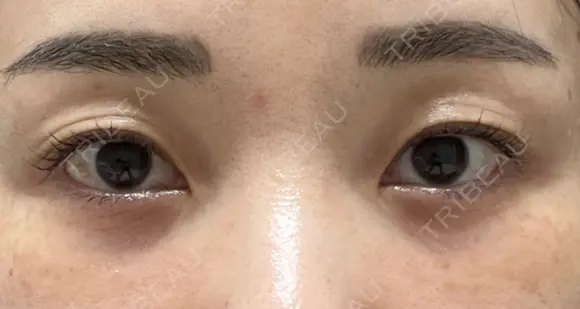 下まぶたの脂肪取り / 脂肪注入（目の下） セオリークリニック DAY 95 メイン用