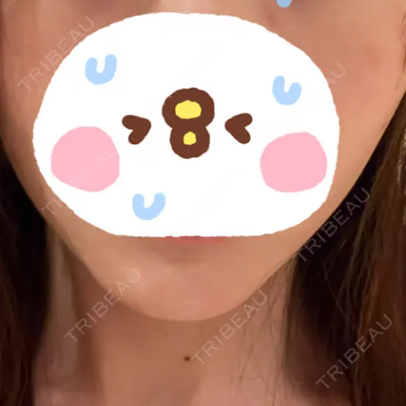 脂肪溶解注射（顔） LIGHT CLINIC 【ライトクリニック】 名古屋院 AFTER メイン用