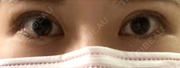 二重埋没 Olino美容外科・美容皮膚科 DAY 15 メイン用