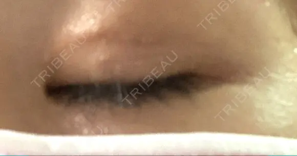 二重埋没 Olino美容外科・美容皮膚科 DAY 15 メイン用