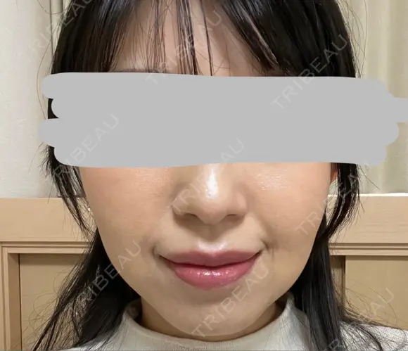 ハイフ（顔） プラチナクリニック DAY 3 メイン用