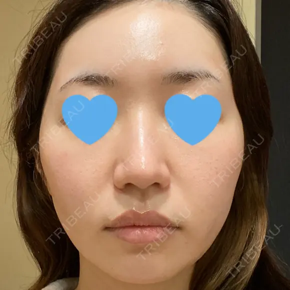 ポテンツァ LOUIS CLINIC 二子玉川院【ルイクリニック】 DAY 6 メイン用