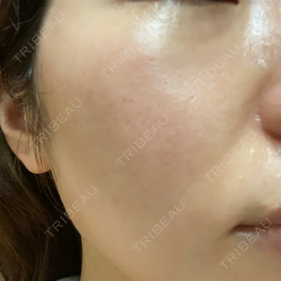 ポテンツァ LOUIS CLINIC 二子玉川院【ルイクリニック】 DAY 6 メイン用