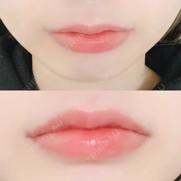 口唇縮小術 B-LINE CLINIC 池袋院 DAY 10 メイン用