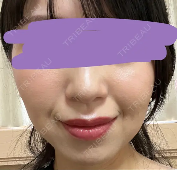 ハイフ（顔） プラチナクリニック DAY 5 メイン用