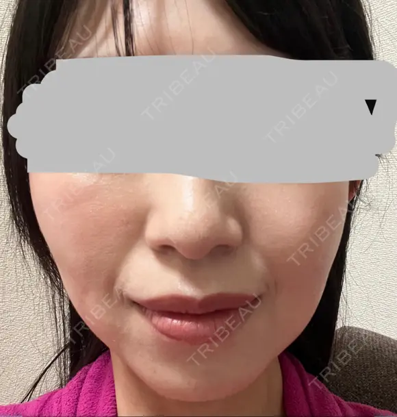 ハイフ（顔） プラチナクリニック DAY 6 メイン用