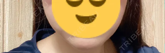 脂肪溶解注射（顔） TCB東京中央美容外科 新潟院 AFTER メイン用