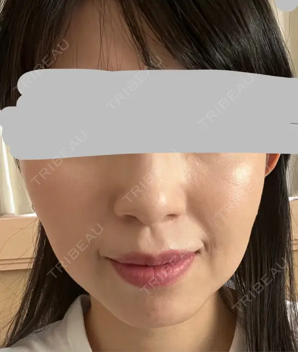 ハイフ（顔） プラチナクリニック DAY 8 メイン用