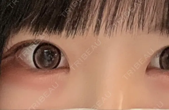 下まぶたの脂肪取り / ヒアルロン酸注入（涙袋） / ヒアルロン酸注入（目の下） / ベビーコラーゲン TCB スキンクリニック 大阪駅前院 DAY 1 メイン用