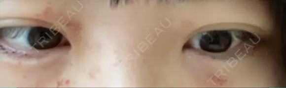 下まぶたの脂肪取り / ヒアルロン酸注入（涙袋） / ヒアルロン酸注入（目の下） / ベビーコラーゲン TCB スキンクリニック 大阪駅前院 DAY 7 メイン用