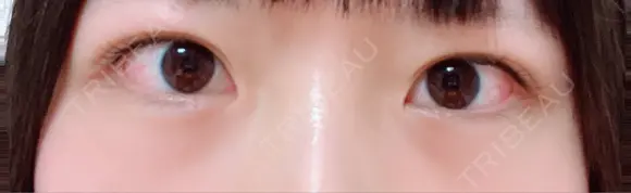 下まぶたの脂肪取り / ヒアルロン酸注入（涙袋） / ヒアルロン酸注入（目の下） / ベビーコラーゲン TCB スキンクリニック 大阪駅前院 AFTER メイン用