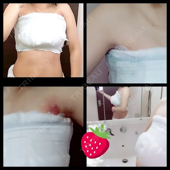 豊胸（シリコンバッグ） 湘南美容クリニック 名古屋栄院 DAY 3 メイン用