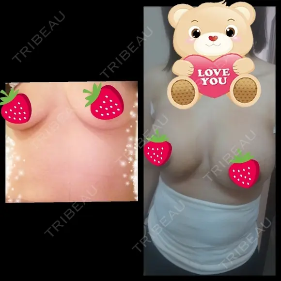 豊胸（シリコンバッグ） 湘南美容クリニック 名古屋栄院 DAY 3 メイン用